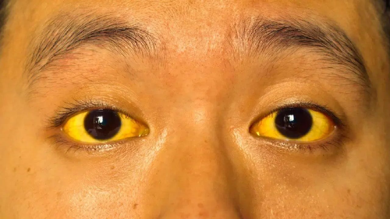 രക്തത്തിലെ ബിലിറൂബിന്റെ അളവ് വര്‍ധിക്കുന്നതാണ് മഞ്ഞപ്പിത്തത്തിന് കാരണമാകുന്നത്. ഇതേതുടര്‍ന്ന് ചര്‍മത്തിലും കണ്ണുകളിലും നഖത്തിലുമെല്ലാം മഞ്ഞനിറം പ്രത്യക്ഷപ്പെടും.
