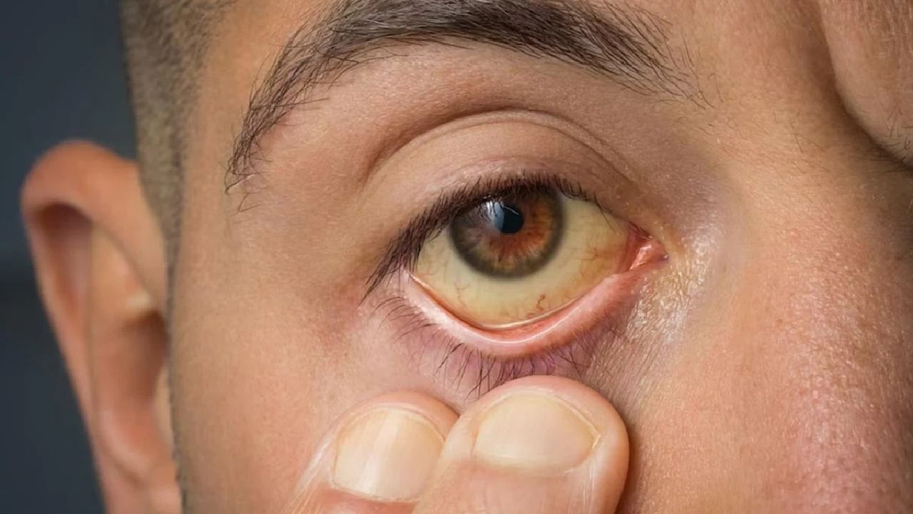 ശരിയായ ചികിത്സാനിര്ണ്ണയവും ചികിത്സയും ആദ്യഘട്ടത്തില് തന്നെ ലഭിച്ചില്ലെങ്കില് രോഗം മൂര്ച്ഛിക്കുന്നതിനും രക്തത്തില് ബിലിറുബിന് 4 മില്ലിഗ്രാം മുതല് 8 മില്ലിഗ്രാമോ അല്ലെങ്കില് അതില് കൂടുതലോ ആകുന്നതിന് കാരണമാകും.