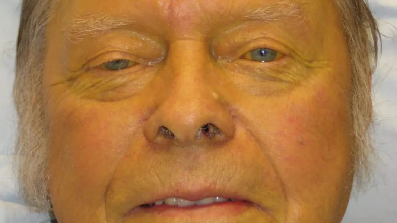 മഞ്ഞനിറത്തിന് പുറമെ വിശപ്പില്ലായ്മ, ഛര്ദി, ക്ഷീണം, പനി, തലകറക്കം, ആഹാരത്തിന് രുചിയില്ലായമ, കരളിന്റെ ഭാഗത്ത് വേദന എന്നിവയാണ് പ്രധാനപ്പെട്ട ലക്ഷണങ്ങള്.