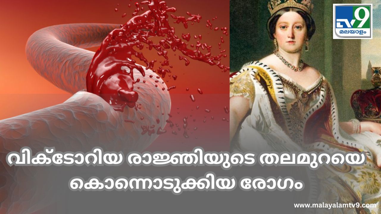 Haemophilia: വിക്ടോറിയ രാജ്ഞിയുടെ തലമുറയെ കൊന്നൊടുക്കിയ രോഗം; രോഗങ്ങളിലെ രാജകിയ പദവിയുള്ള ഹീമോഫീലിയ Haemophilia: വിക്ടോറിയ രാജ്ഞിയുടെ തലമുറയെ കൊന്നൊടുക്കിയ രോഗം; രോഗങ്ങളിലെ രാജകിയ പദവിയുള്ള ഹീമോഫീലിയ