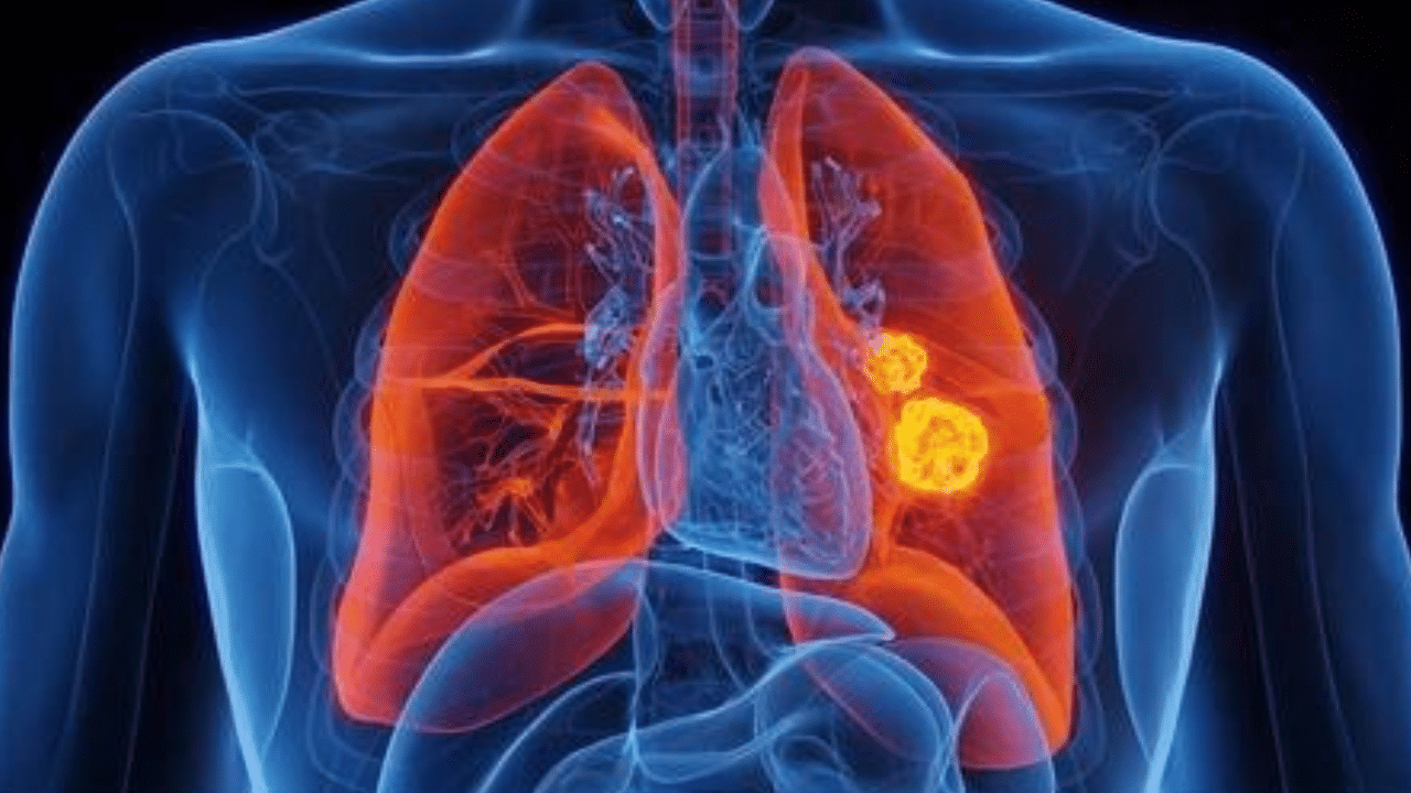 Lung Cancer Vaccine: ശ്വാസകോശ അർബുദത്തിന് വാക്സിൻ; ആദ്യമായി പരീക്ഷിച്ചത് യുകെയിലെ ഒരു രോഗിയിൽ Lung Cancer Vaccine: ശ്വാസകോശ അർബുദത്തിന് വാക്സിൻ; ആദ്യമായി പരീക്ഷിച്ചത് യുകെയിലെ ഒരു രോഗിയിൽ