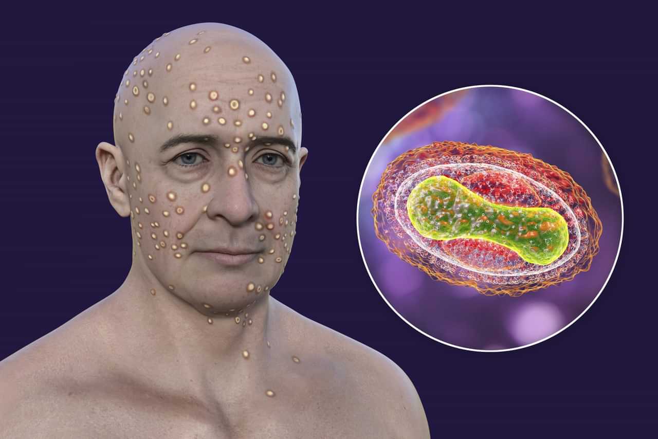 Mpox in India: കുരങ്ങുപനിയെ ഇന്ത്യക്കാർ പേടിക്കണോ? രാജ്യത്തിന്റെ പ്രതിരോധം ഇങ്ങനെ...