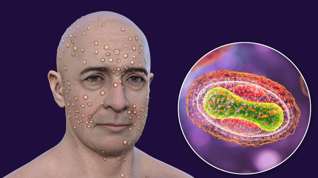 Kerala Mpox Update:  ആശങ്ക തുടരുന്നു, സംസ്ഥാനത്ത് വീണ്ടും എംപോക്സ്? ഹരിപ്പാട് സ്വദേശി നിരീക്ഷണത്തിൽ
