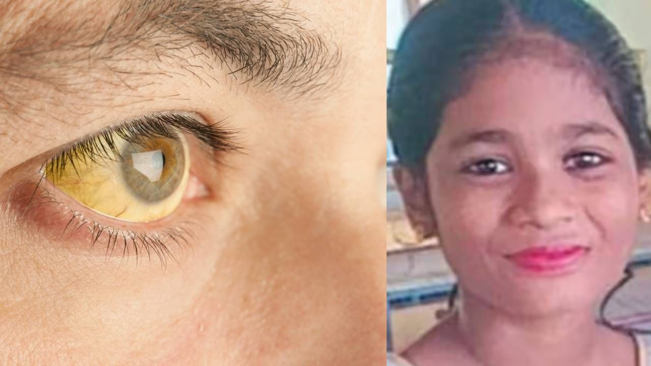 Jaundice: സംസ്ഥാനത്ത് വീണ്ടും മഞ്ഞപ്പിത്തം ബാധിച്ച് മരണം: കരുതൽ വിടരുത് ; അറിയാം രോഗപ്പകർച്ചയും ലക്ഷണങ്ങളും Jaundice: സംസ്ഥാനത്ത് വീണ്ടും മഞ്ഞപ്പിത്തം ബാധിച്ച് മരണം: കരുതൽ വിടരുത് ; അറിയാം രോഗപ്പകർച്ചയും ലക്ഷണങ്ങളും