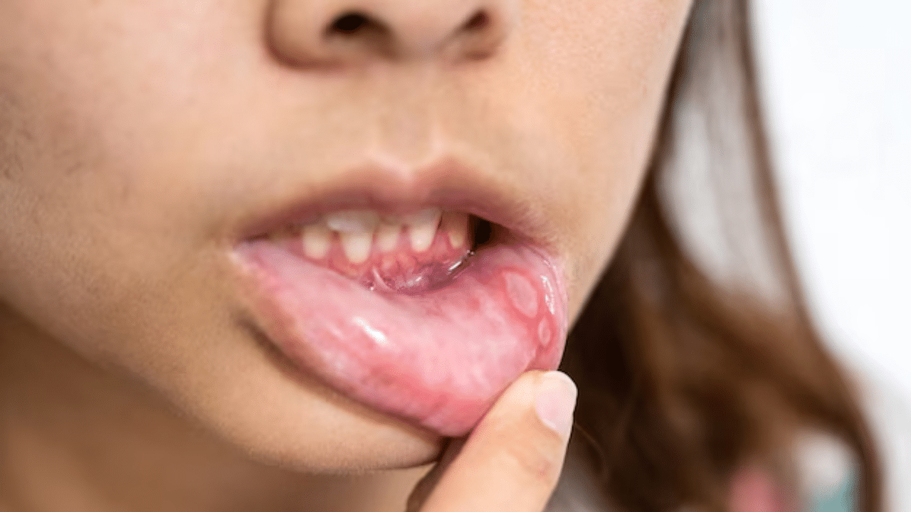 How to cure mouth ulcers