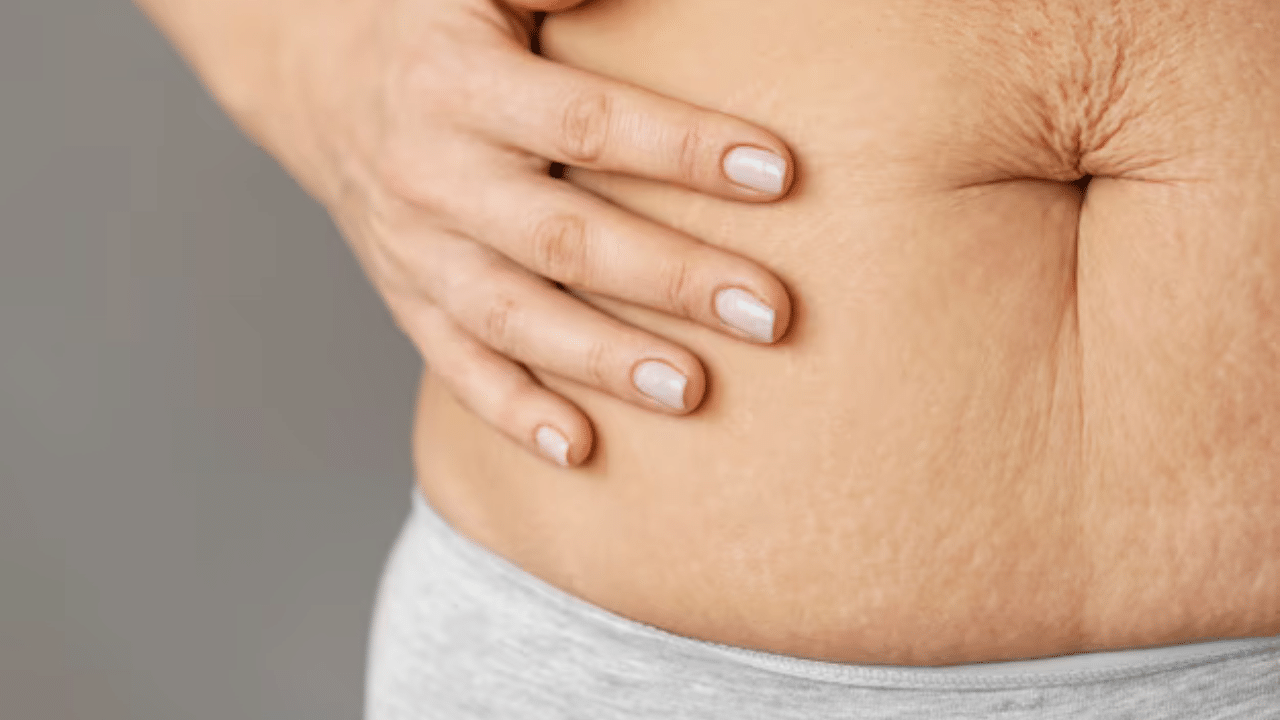 Stretch Mark: സ്ട്രെച്ച് മാർക്കുകൾ മാറ്റാൻ പാടുപെടുന്നുണ്ടോ? ഇതാ എളുപ്പ വഴി