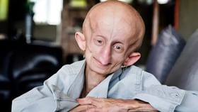 Hutchinson Gilford progeria syndrome : ബാല്യത്തില്‍ തന്നെ വാര്‍ധക്യം; ബിയാന്ദ്രിയിലൂടെ ലോകം അറിഞ്ഞ അപൂര്‍വരോഗം; എന്താണ് പ്രൊജീരിയ സിന്‍ഡ്രോം ?