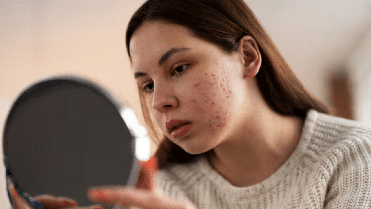 What Food To Eat Control Hormonal Acne