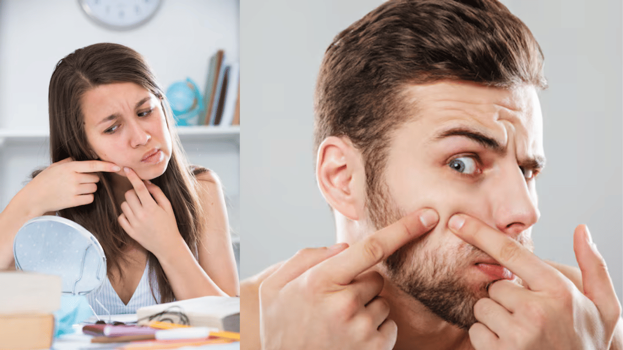 Acne: മുഖക്കുരു പൊട്ടിച്ചാൽ മരണമോ...? സൂക്ഷിച്ചില്ലേൽ പണി പാളും; കാരണം ഇത്, ഡെർമറ്റോളജിസ്റ്റ് പറയുന്നത് ഇങ്ങനെ Acne: മുഖക്കുരു പൊട്ടിച്ചാൽ മരണമോ...? സൂക്ഷിച്ചില്ലേൽ പണി പാളും; കാരണം ഇത്, ഡെർമറ്റോളജിസ്റ്റ് പറയുന്നത് ഇങ്ങനെ