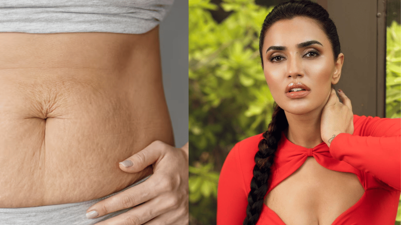 Stretch Marks Removal: സ്ട്രെച്ച് മാർക്ക് നീക്കാം ഈസിയായി, ചെയ്യേണ്ടത് ഇത്രമാത്രം: രഹസ്യം വെളിപ്പെടുത്തി തെന്നിന്ത്യൻ താരം