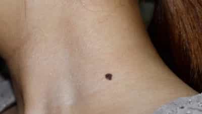 Malayalam Astro Tips: ശരീരത്തിലെ മറുക്  ധനികനാക്കും, ഭാഗ്യം തരുന്ന ലക്ഷണങ്ങൾ