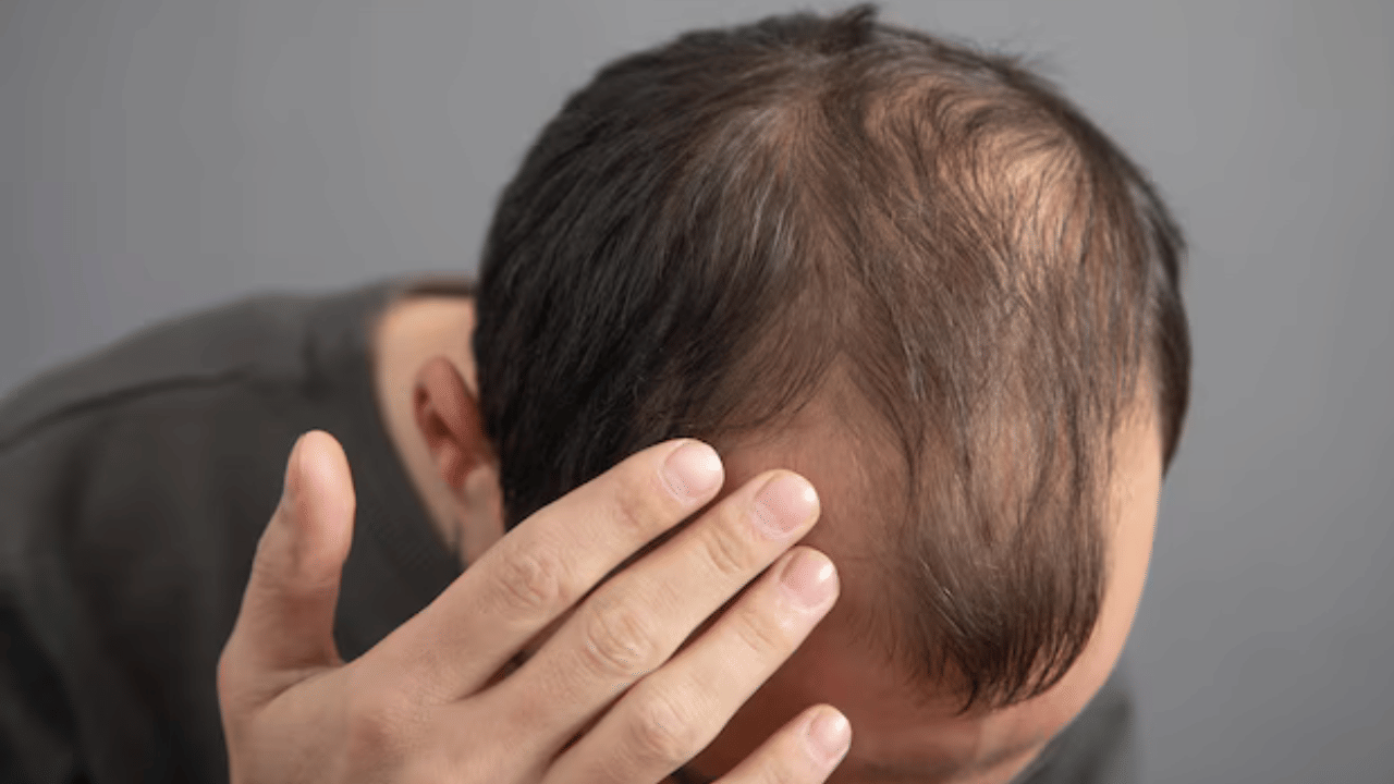 Castor Oil For Hair: കഷണ്ടി വന്നാലെന്തു ചെയ്യും? മുടി വീണ്ടും വളരും; ആവണക്കണ്ണ ഇങ്ങനെ ഉപയോ​ഗിച്ചു നോക്കൂ