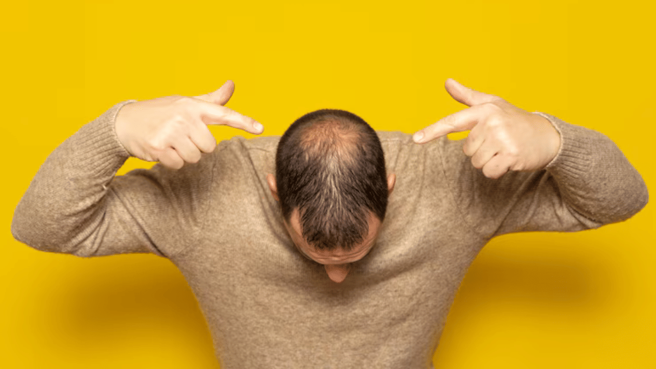 Bald Patches: വെറുതെയല്ല കഷണ്ടി വരുന്നത്..! ഈ തെറ്റുകൾ നിങ്ങളെ കഷണ്ടിയുള്ളവരാക്കുന്നു