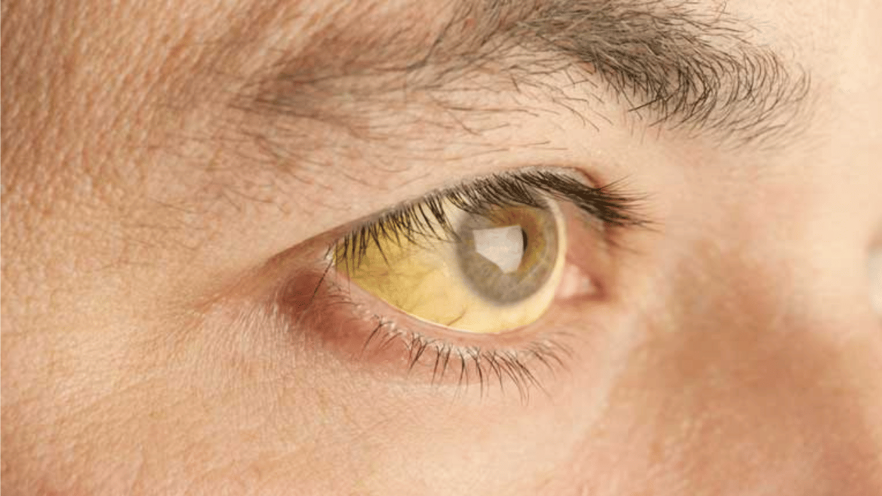 Kerala Jaundice Outbreak: സംസ്ഥാനത്ത് മഞ്ഞപ്പിത്തം പടരുന്നു; ജാ​ഗ്രത, ലക്ഷണങ്ങളും ചികിത്സയും എന്തെല്ലാം?