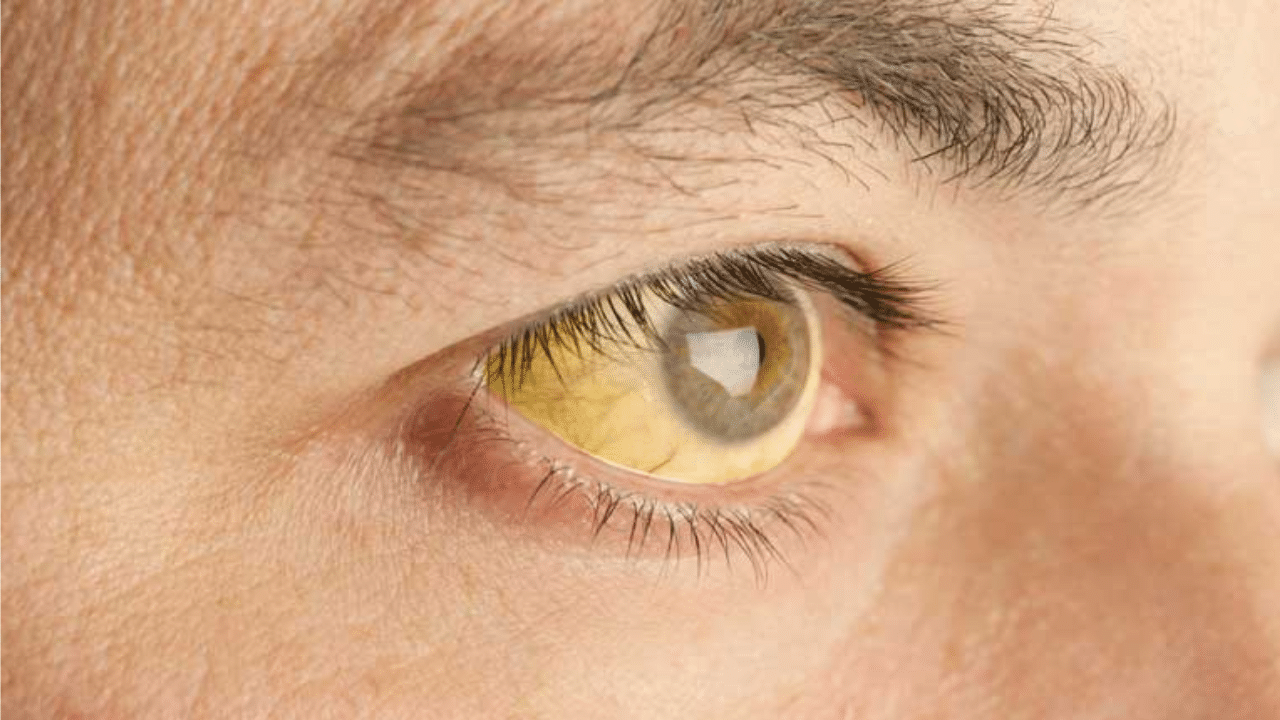 Kerala Jaundice Outbreak: സംസ്ഥാനത്ത് മഞ്ഞപ്പിത്തം പടരുന്നു; ജാ​ഗ്രത, ലക്ഷണങ്ങളും ചികിത്സയും എന്തെല്ലാം?