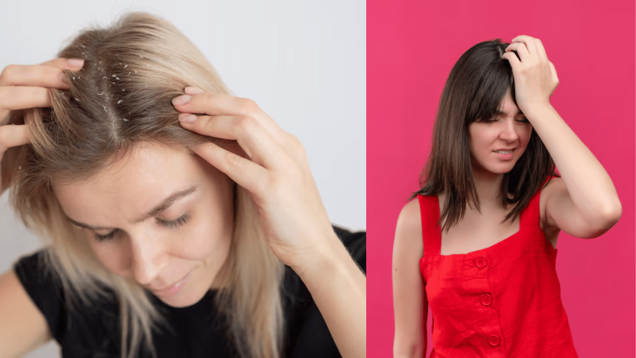 Scalp Infections: ചൂടുകാലത്ത് തലയോട്ടിയിലെ പ്രശ്നങ്ങൾ എങ്ങനെ പരിഹരിക്കാം; കാരണങ്ങൾ ഇവയാണ്
