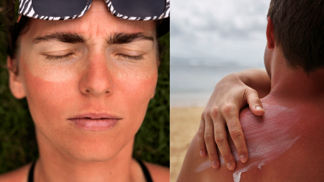 Sunburn Remedies: വെയിലേറ്റ് നിങ്ങൾ കരിവാളിച്ചോ? എങ്കിൽ വിഷമികേണ്ട അടുക്കളയിലുണ്ട് പരിഹാരം Sunburn Remedies: വെയിലേറ്റ് നിങ്ങൾ കരിവാളിച്ചോ? എങ്കിൽ വിഷമികേണ്ട അടുക്കളയിലുണ്ട് പരിഹാരം