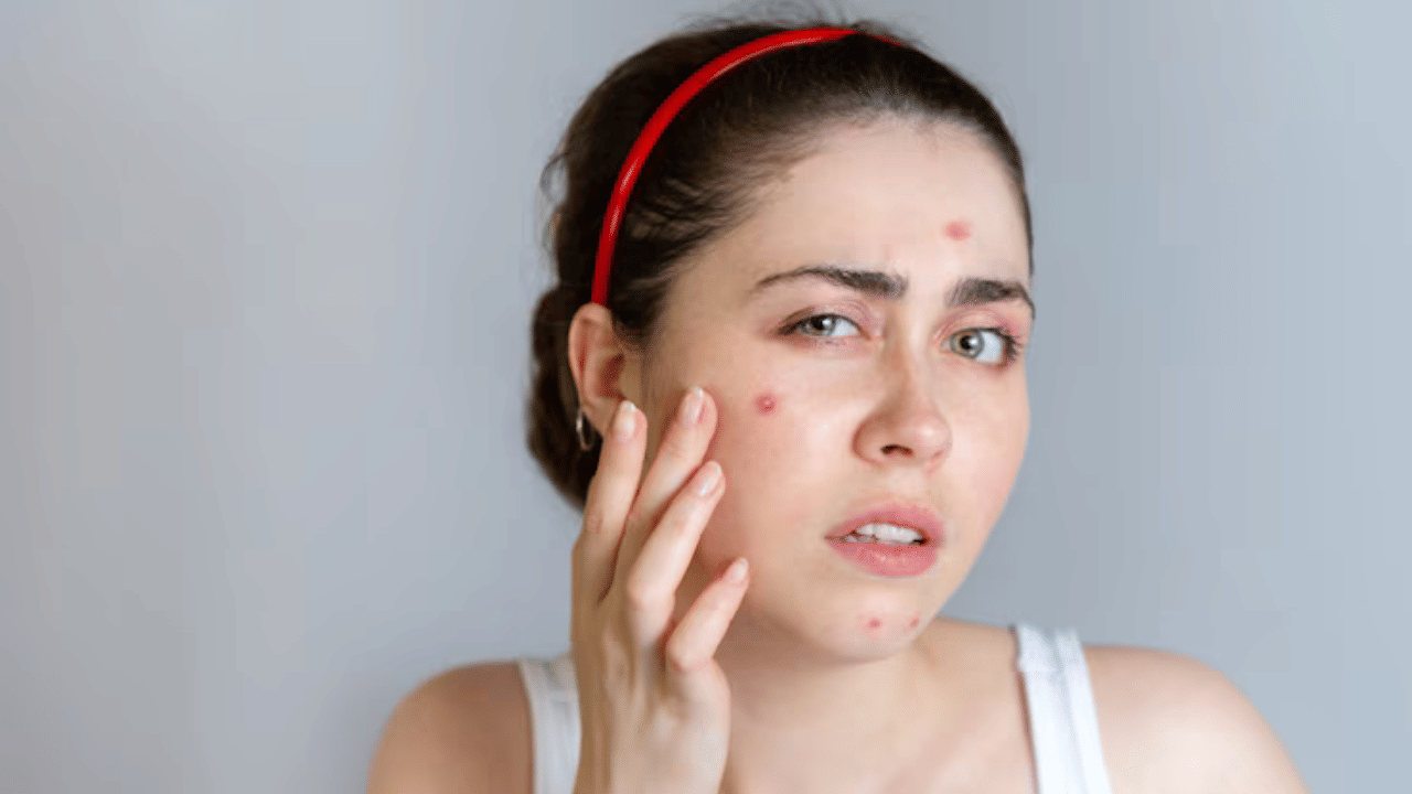 Pimples Free Skin: മുതിർന്നവരിലും മുഖക്കുരുവോ? കാരണം ഇതാണ്; വിഷമിക്കേണ്ട വീട്ടിലുണ്ട് പരിഹാരം Pimples Free Skin: മുതിർന്നവരിലും മുഖക്കുരുവോ? കാരണം ഇതാണ്; വിഷമിക്കേണ്ട വീട്ടിലുണ്ട് പരിഹാരം