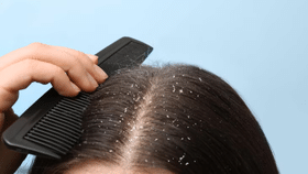 Dandruff home remedies: താരനാണോ പ്രശ്നം, പരിഹാരം വീട്ടിൽ തന്നെയുണ്ട്!...
