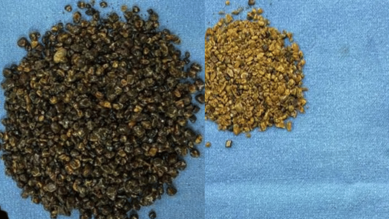 Gallstones Removed: വേദനയിൽ നിന്ന് മോചനം, 5 വർഷത്തിനുശേഷം നീക്കം ചെയ്തത് 8,000 ത്തിലധികം പിത്താശയക്കല്ലുകൾ