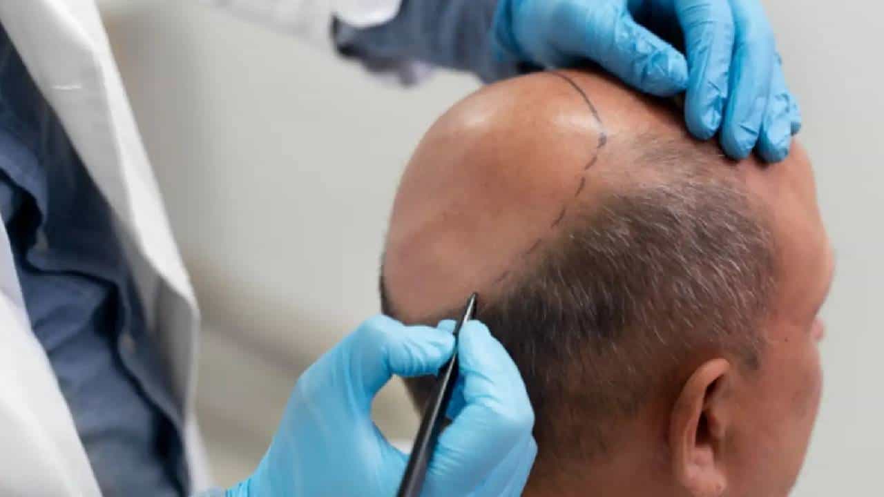 ‌Hair Transplant Death: മുടി മാറ്റിവെയ്ക്കല്‍ ശസ്ത്രക്രിയക്ക് വിധേയനായ യുവ എഞ്ചിനീയർ മരിച്ചു; കാരണം അണുബാധ