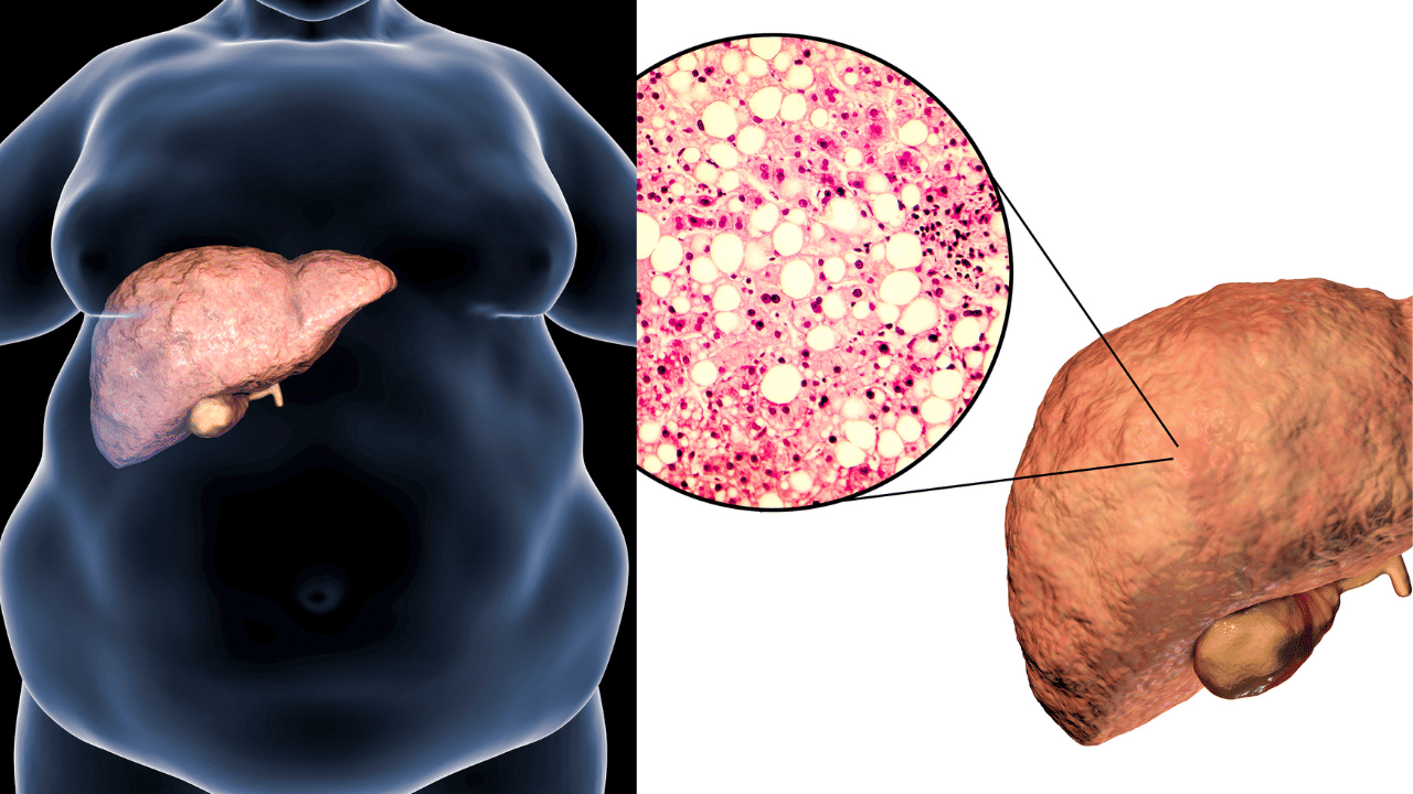 Fatty liver: രാത്രി സമയങ്ങളിൽ അമിതമായി വിയർക്കാറുണ്ടോ? ഈ ലക്ഷണങ്ങൾ തിരിച്ചറിയണം Fatty liver: രാത്രി സമയങ്ങളിൽ അമിതമായി വിയർക്കാറുണ്ടോ? ഈ ലക്ഷണങ്ങൾ തിരിച്ചറിയണം
