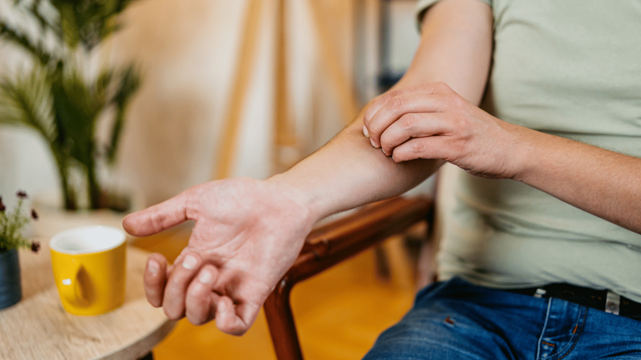 Mosquito Bites: തടിപ്പ് പിന്നെ പനി! കൊതുക് കടിക്കുന്നതിലൂടെ ഉണ്ടാകുന്ന അലർജി ജീവന് അപകടമോ?