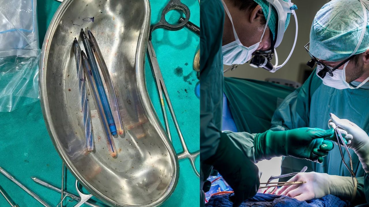 Viral News : കടുത്ത വയറുവേദനയും ഛർദിയും; പരിശോധിച്ചപ്പോൾ 28കാരിയുടെ വയറ്റിൽ നാല് പേനകൾ