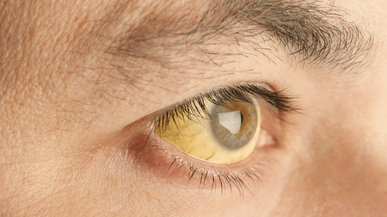 അതിൽ ആദ്യത്തേത് ചർമ്മത്തിന്റെയും കണ്ണുകളുടെയും മഞ്ഞ നിറമാണ്. ബിലിറൂബിൻ അളവ് കൂടുന്നതാണ് ഇതിന് കാരണം. ബിലിറൂബിൻ കൃത്യമായി നീക്കം ചെയ്യാനും മറ്റും കരളിന് കഴിയാതെ വരുന്നതാണ് ഇതിന്റെ കാരണം.