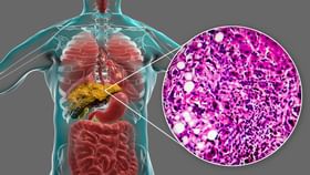 Bile Disease: എന്താണ് പിത്ത രോഗം.. ഈ അവസ്ഥയുള്ളവർ അരിവാരി തിന്നുമോ?; പ്രതിവിധി എന്ത് Bile Disease: എന്താണ് പിത്ത രോഗം.. ഈ അവസ്ഥയുള്ളവർ അരിവാരി തിന്നുമോ?; പ്രതിവിധി എന്ത്...