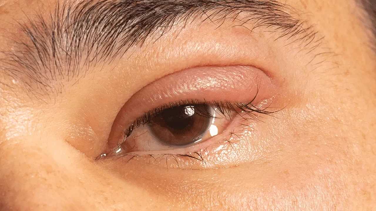 Health Tips: കണ്ണുകളിൽ ഈ ലക്ഷണങ്ങളുണ്ടോ ? വലിയ രോഗമാവാം Health Tips: കണ്ണുകളിൽ ഈ ലക്ഷണങ്ങളുണ്ടോ ? വലിയ രോഗമാവാം