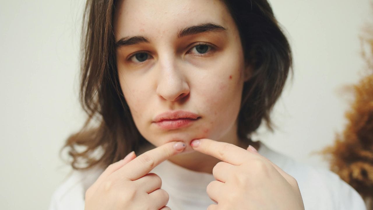 കട്ടിയായി ആണി പോലെ വരുന്ന മുഖക്കുരുവാണെങ്കിൽ പതിയെ ഇളക്കിയെടുത്ത് കളയാം. കാരണം അത്തരം മുഖക്കുരു മൂന്നോ നാലോ ദിവസങ്ങൾ കഴിയുമ്പോഴേക്കും കട്ടിയായി പുറത്തേക്ക് തെറിച്ച് നില്‍ക്കും. ഇത് എളുപ്പത്തിൽ ഇളക്കിയെടുക്കാനും കഴിയും. (Image Credits: Pexels)
