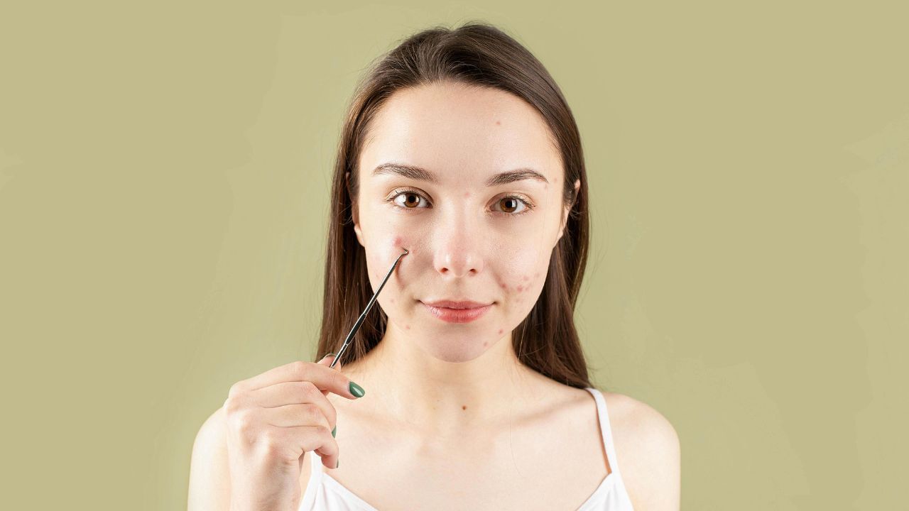 ഇതുപോലെ പൊട്ടിച്ചുകളയുന്ന കുരു വീണ്ടുമുണ്ടാകാനുള്ള സാധ്യത ഉണ്ട്. അതുപോലെ തന്നെ, സ്ഥിരമായി മുഖക്കുരു പൊട്ടിച്ചുകളയുമ്പോൾ അവിടെ 'സിസ്റ്റ്' (ചെറിയ മുഴ) രൂപപ്പെടാനുള്ള സാധ്യതയും ഉണ്ട്. ഇത് പിന്നീട് ചികിത്സയില്ലാതെ മാറില്ലെന്ന അവസ്ഥയിലേക്ക് എത്തിക്കും. (Image Credits: Pexels)