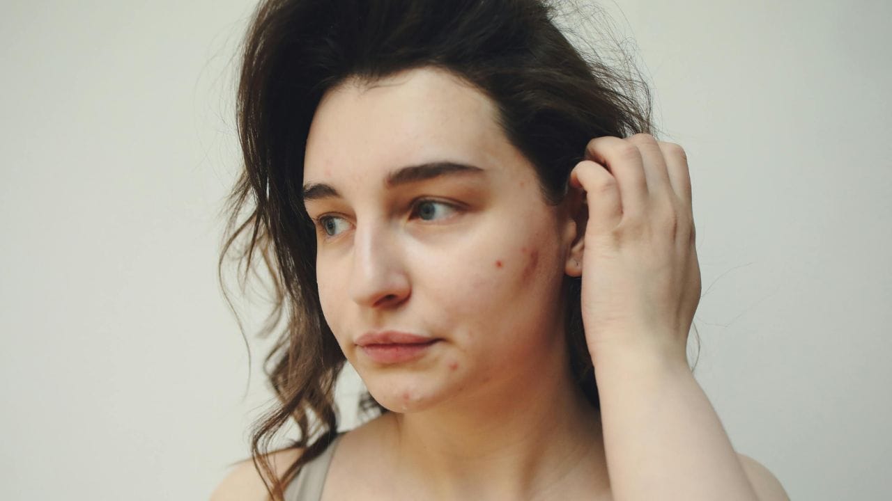 നിങ്ങള്‍ മുഖക്കുരു പൊട്ടിച്ച് കളയുമ്പോള്‍ ആ ഭാഗത്ത് എന്നെന്നേക്കുമായി തന്നെ ചെറിയ കറുത്ത പാടുകള്‍ ഉണ്ടാകുന്നു. അത് കൊണ്ടുതന്നെ, മുഖക്കുരു പൊട്ടിച്ചുകളയാതിരിക്കാൻ പ്രത്യേകം ശ്രദ്ധിക്കുക. (Image Credits: Pexels)
