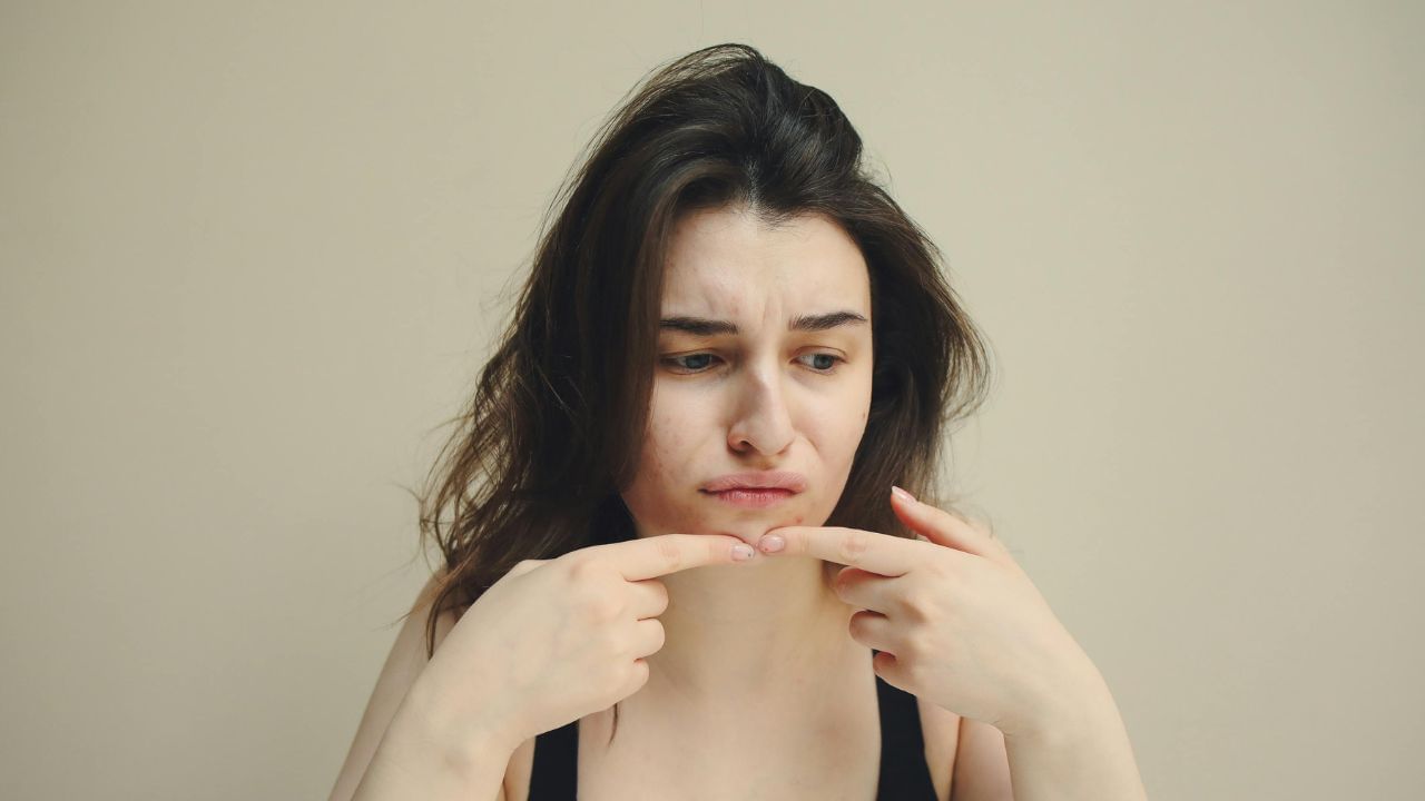 മുഖക്കുരു പല കാരണങ്ങള് കൊണ്ടും വരാം. ഹോര്മോണ് വ്യതിയാനം, കാലാവസ്ഥ, ഭക്ഷണം മുതൽ മാനസിക സമ്മര്ദ്ദം വരെ ഇതിന് ഇടയാക്കാറുണ്ട്. എന്തുതരം മുഖക്കുരുവാണെങ്കിലും അത് പലരും പൊട്ടിച്ചുകളയാറുണ്ട്. (Image Credits: Pexels)