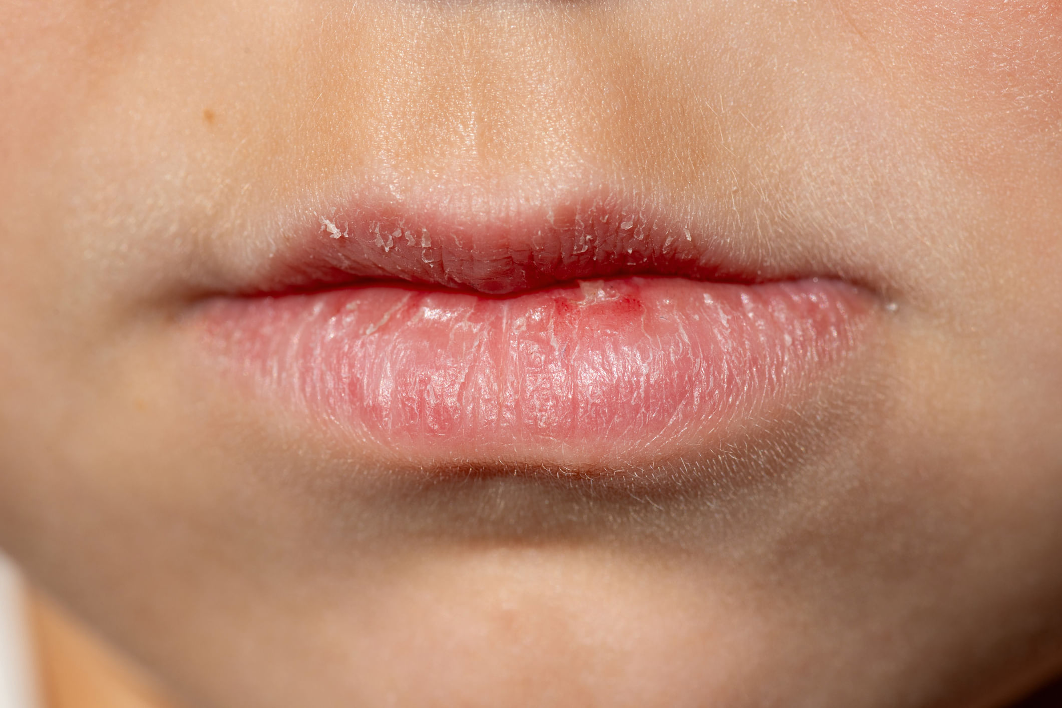 ചുണ്ടുകളിലെ കറുപ്പ് നിറം പലരെയും അലട്ടുന്ന പ്രശ്നമാണ്. മുഖം എത്ര തിളങ്ങിയാലും ചുണ്ടുകളിലെ കറുപ്പ് മറയ്ക്കാൻ ബുദ്ധിമുട്ടാണ്. കറുത്ത ചുണ്ടുകൾക്ക് നിരവധി കാരണങ്ങളാണുള്ളത്. ധാരാളം വെള്ളം കുടിക്കുന്നത് ചുണ്ടുകളുടെയും ചർമ്മത്തിൻ്റെയും ആരോഗ്യത്തിന് നല്ലതാണ്. പോഷകാഹാരക്കുറവ് മൂലമാണ് ചുണ്ടിന് കറുപ്പ് നിറം വരുന്നതെങ്കിൽ, വിറ്റാമിൻ ബി 12 പോലുള്ള വിറ്റാമിനുകൾ അടങ്ങിയ ഭക്ഷണങ്ങൾ കൂടുതൽ കഴിക്കേണ്ടതാണ്. (Image Credits: