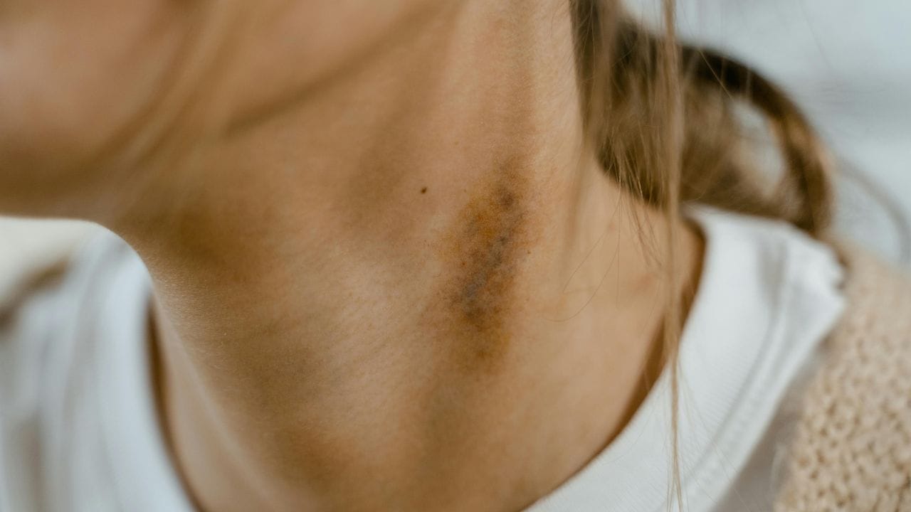 മെലാനോസൈറ്റുകൾ എന്ന കോശങ്ങൾ അധികമായി പ്രവർത്തിക്കുമ്പോഴാണ് ഹൈപ്പർപിഗ്‌മെന്റേഷൻ ഉണ്ടാകുന്നത്. ചർമ്മത്തിന് നിറം നൽകുന്ന മെലാനിൻ ഉത്പാദിപ്പിക്കുന്ന കോശങ്ങളാണ് മെലാനോസൈറ്റുകൾ. (Image Credits: Pexels)
