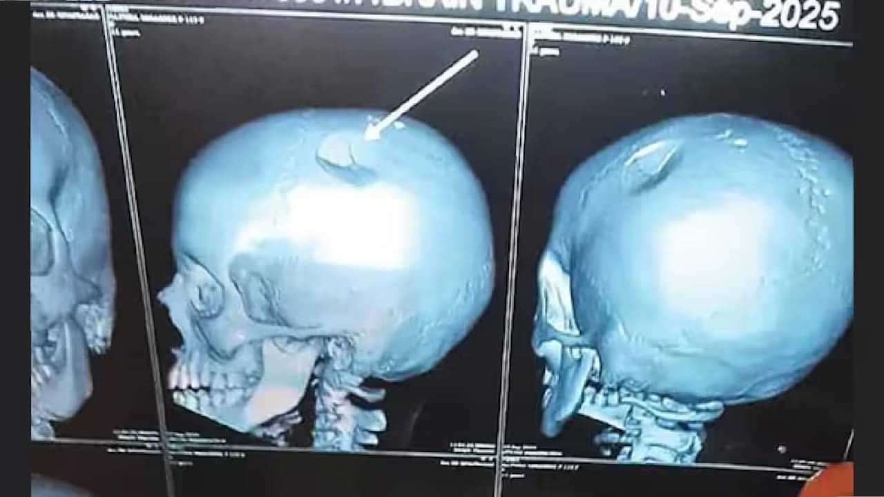 Teacher Hits Students With Lunch Box: ക്ലാസിൽ മോശമായി പെരുമാറി; വിദ്യാര്‍ത്ഥിനിയുടെ തലയില്‍ അധ്യാപിക ചോറ്റുപാത്രം കൊണ്ടിടിച്ചു; തലയോട്ടിക്ക് പൊട്ടല്‍