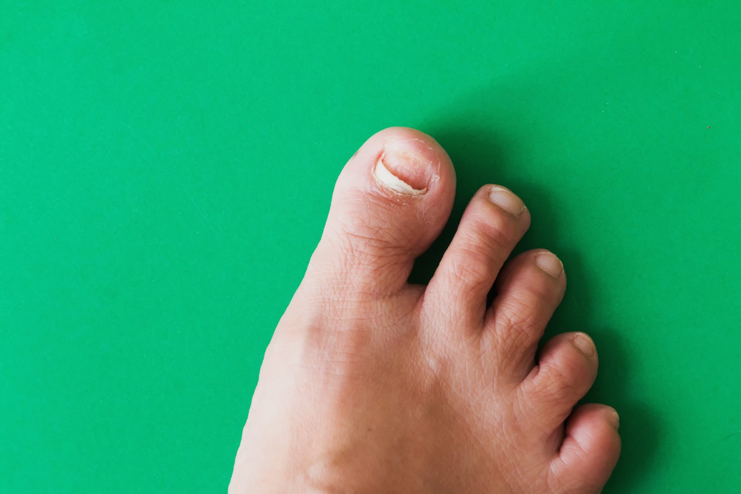 നഖങ്ങളുടെ ആരോഗ്യത്തിൽ ഭക്ഷണക്രമം ഒരു പ്രധാന പങ്ക് വഹിക്കുന്നു. പോഷകാഹാരത്തിൻ്റെ കുറവ് മൂലവും നഖങ്ങൾ പൊട്ടിപോകാനും മറ്റ് പരിക്കുകൾക്കും കാരണമാകും. ഇരുമ്പിന്റെ കുറവാണ് നഖങ്ങൾ പൊട്ടുന്നതിന് പ്രധാന കാരണം. സിങ്ക്, ബയോട്ടിൻ, പ്രോട്ടീൻ, വിറ്റാമിൻ എ, സി എന്നിവയുൾപ്പെടെയുള്ള മറ്റ് പോഷകങ്ങളും പ്രധാനമാണ്. അതിനാൽ ഇവയടങ്ങിയ ഭക്ഷണങ്ങൾ കഴിക്കുക. (Image Credits: Getty Images)
