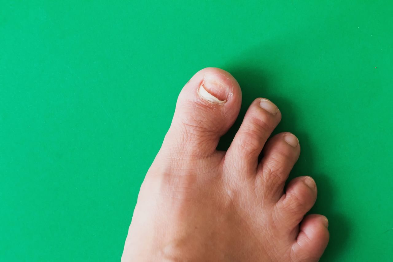 നഖങ്ങളുടെ ആരോഗ്യത്തിൽ ഭക്ഷണക്രമം ഒരു പ്രധാന പങ്ക് വഹിക്കുന്നു. പോഷകാഹാരത്തിൻ്റെ കുറവ് മൂലവും നഖങ്ങൾ പൊട്ടിപോകാനും മറ്റ് പരിക്കുകൾക്കും കാരണമാകും. ഇരുമ്പിന്റെ കുറവാണ് നഖങ്ങൾ പൊട്ടുന്നതിന് പ്രധാന കാരണം. സിങ്ക്, ബയോട്ടിൻ, പ്രോട്ടീൻ, വിറ്റാമിൻ എ, സി എന്നിവയുൾപ്പെടെയുള്ള മറ്റ് പോഷകങ്ങളും പ്രധാനമാണ്. അതിനാൽ ഇവയടങ്ങിയ ഭക്ഷണങ്ങൾ കഴിക്കുക. (Image Credits: Getty Images)