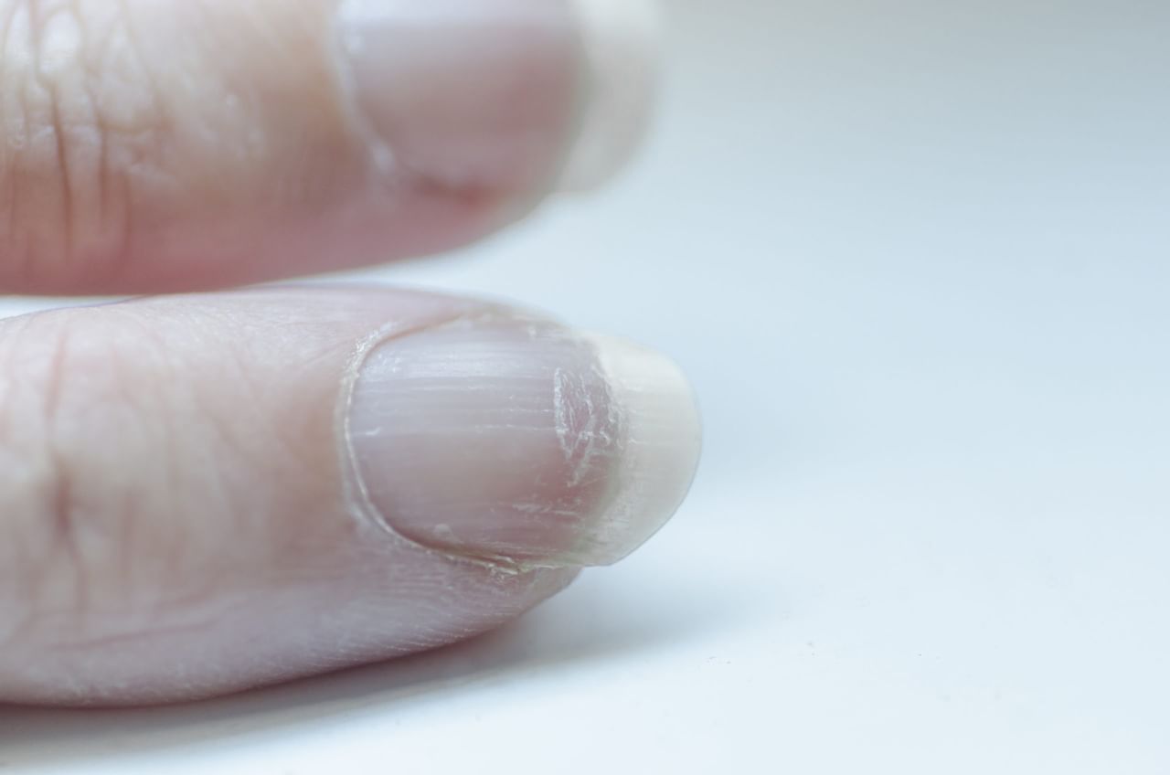 മോയ്സ്ചറൈസറുകളും ഹാൻഡ് ക്രീമുകളും ഉപയോ​ഗിക്കുന്നത് നഖങ്ങളുടെ ചുറ്റുമുള്ള ചർമ്മത്തിൽ ഈർപ്പം നിലനിർത്തുകയും ഇത് നഖത്തിൻ്റെ പ്രശ്നങ്ങൾ കുറയ്ക്കുകയും ചെയ്യുന്നു. പാർലറുകളിൽ പോയി മാനിക്യുർ പോലുള്ള നഖത്തിന് കേടുപാടുകൾ വരുത്തുന്ന പരിചരണം പൂർണമായും ഒഴിവാക്കുക. ഇലക്കറികൾ, മുട്ട, പരിപ്പ്, വിത്തുകൾ തുടങ്ങിയവ സ്ഥിരമായി കഴിക്കുന്നതും നഖത്തിൻ്റെ ആരോ​ഗ്യത്തെ കാക്കുന്നു. (Image Credits: Getty Images)