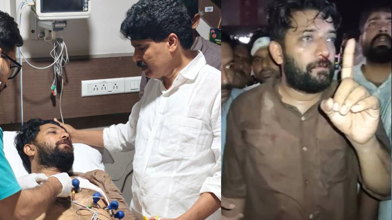 Perambra CLash: ഷാഫി പറമ്പിലിന്റെ മൂക്കിനു പൊട്ടൽ; അടിയന്തിര ശാസ്ത്രക്രിയക്ക് വിധേയനാക്കി