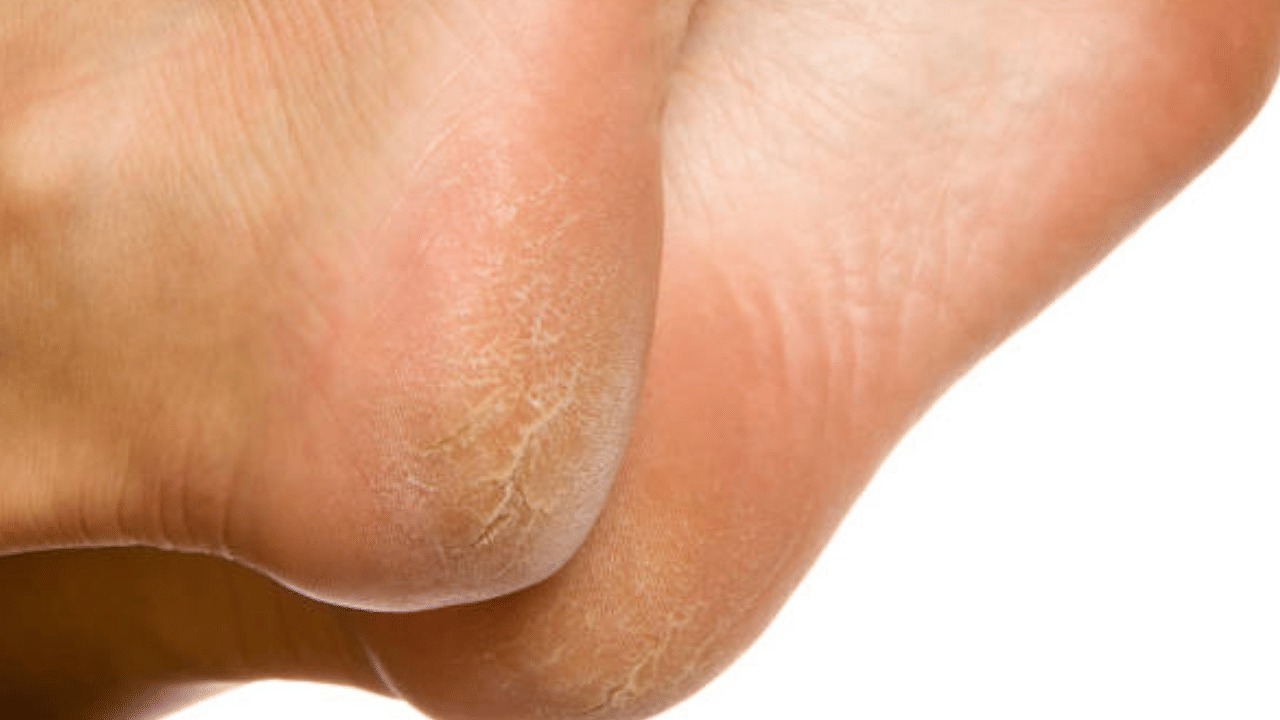 Cracked Heels: കാൽപാദം വിണ്ടുകീറുന്നുണ്ടോ? പരിഹാരം വീട്ടിൽ തന്നെയുണ്ട്!
