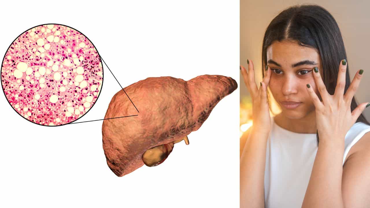 Fatty Liver: ഫാറ്റി ലിവർ രോഗം ചർമ്മത്തെ ബാധിക്കുമോ? ലക്ഷണങ്ങളും പരിഹാരങ്ങളും അറിയാം Fatty Liver: ഫാറ്റി ലിവർ രോഗം ചർമ്മത്തെ ബാധിക്കുമോ? ലക്ഷണങ്ങളും പരിഹാരങ്ങളും അറിയാം
