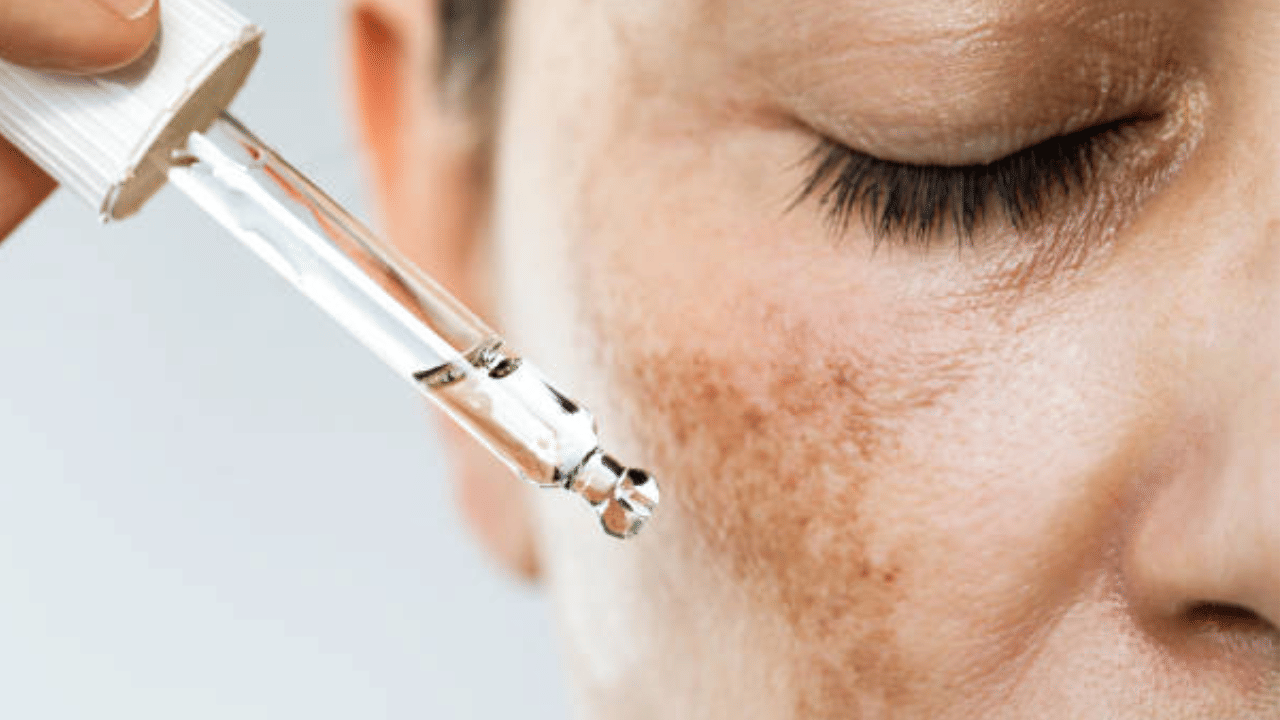 Hyperpigmentation: മുഖത്തെ കറുത്തപാടാണോ പ്രശ്നം? വീട്ടിൽ തന്നെ വഴിയുണ്ട്