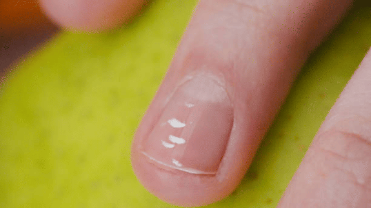 High cholesterol: നഖങ്ങൾ പൊട്ടിപ്പോകുന്നുണ്ടോ, വെളുത്ത പാടുകളുണ്ടോ; അവഗണിക്കല്ലേ... ഇവയുടെ ലക്ഷണങ്ങളാകാം