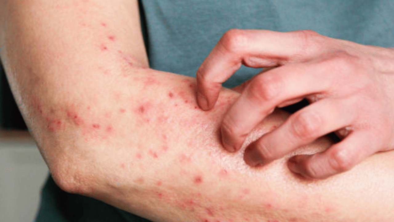 Diabetes Skin Symptoms: ചർമത്തിൽ ഈ പാടുകൾ ഉണ്ടോ? പ്രമേഹത്തിന്റെ ലക്ഷണമാകാം!