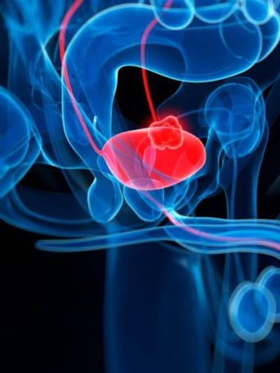 മൂത്രാശയ ക്യാൻസറിന്റെ അഞ്ച് ലക്ഷണങ്ങൾ ഇവയാണ്