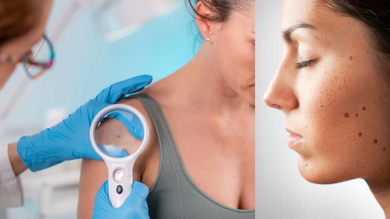 Health Care: മറുകുകൾ സ്വന്തമായി നീക്കം ചെയ്യാറുണ്ടോ? അപകടം ക്ഷണിച്ചുവരുത്തരുത്