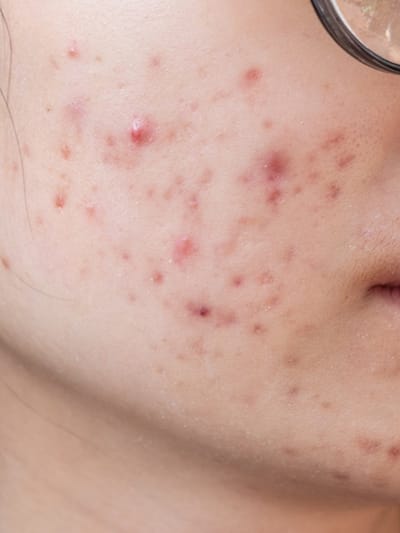 മുഖക്കുരുവിനെ പമ്പ കടത്താം, ഇതാ ടിപ്‌സ്‌